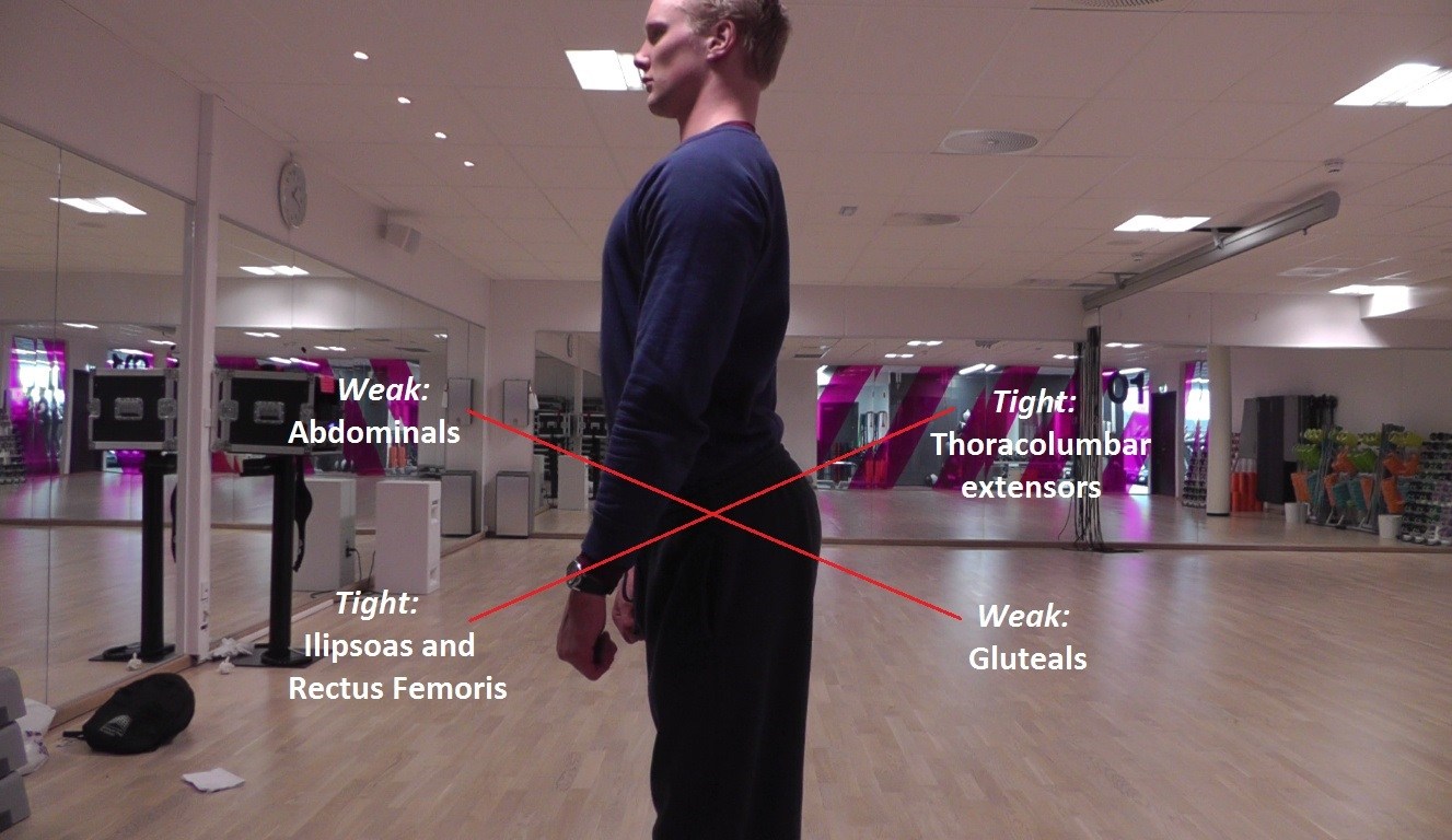 Lower Crossed Posture