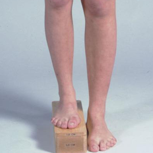 Short Right Leg Syndrome