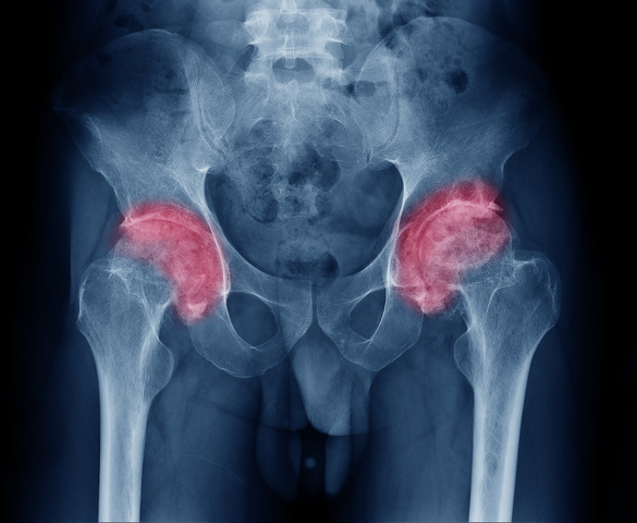 Arthritisx rayhip