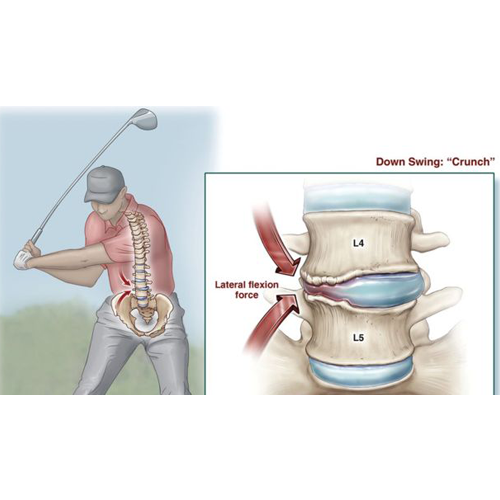 golf pain