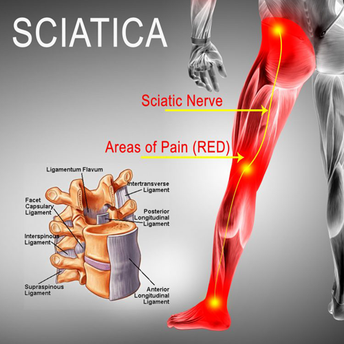 sciatica