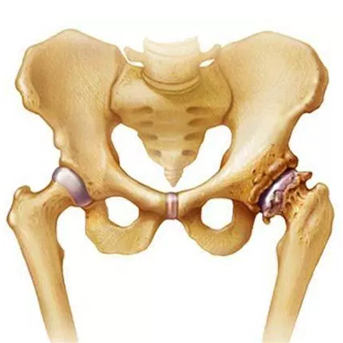 hip arthritis