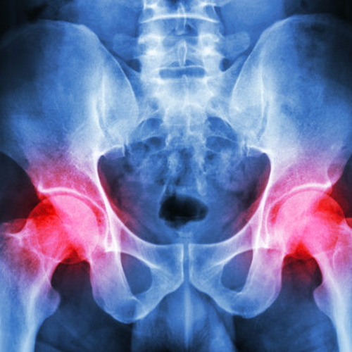 hip arthritis