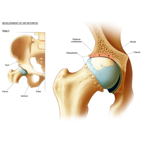 hip arthritis