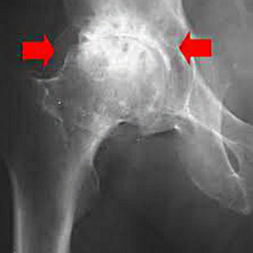 inflamed hip