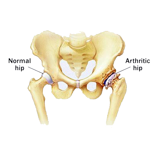 inflamed hip