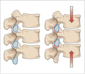 Lx spine