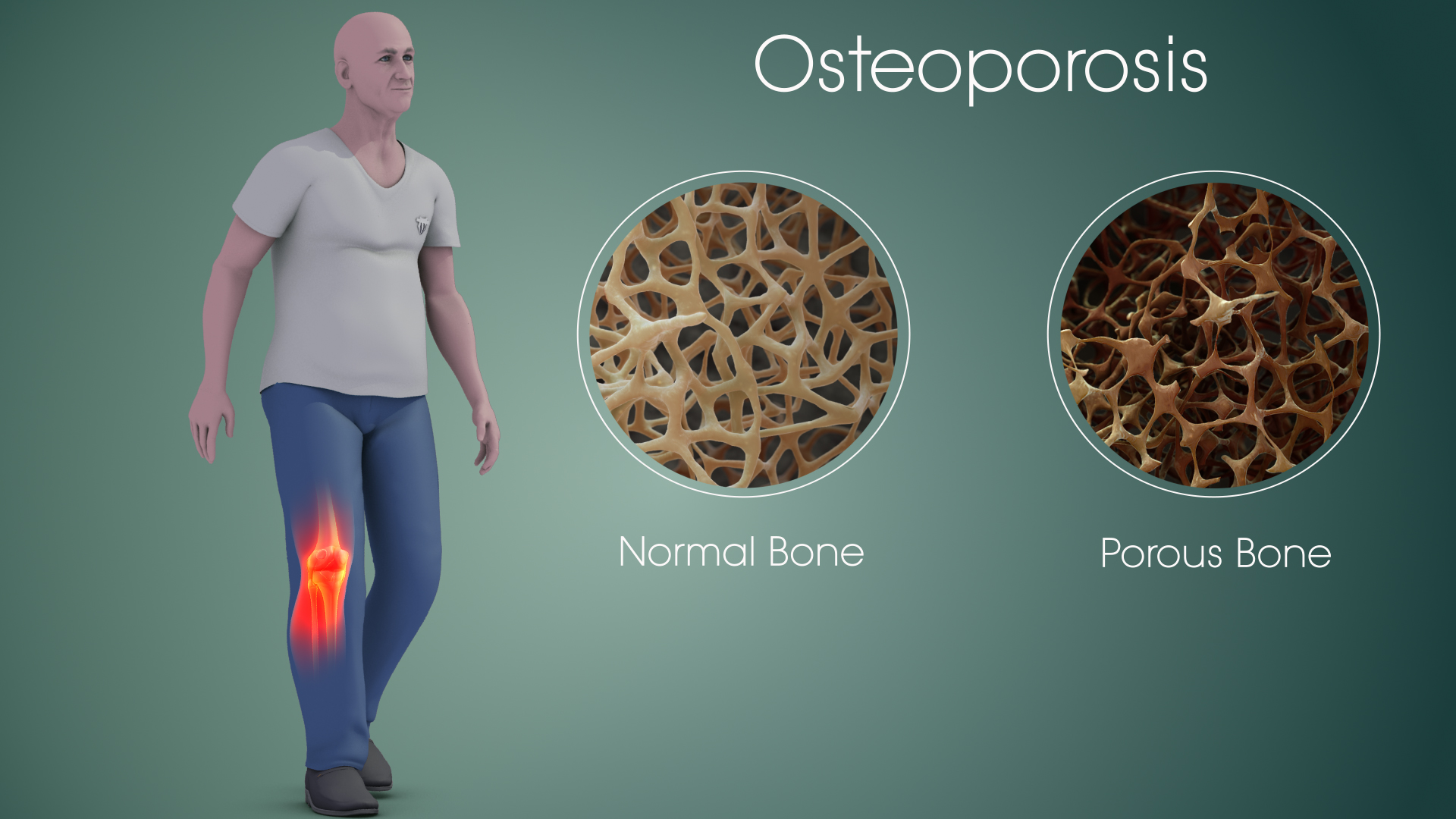 OSTEOPOROSIS