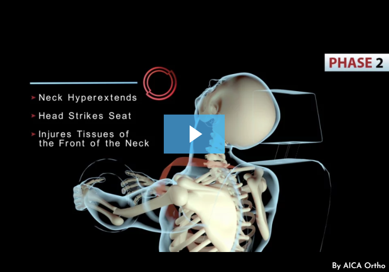 Whiplash Injuries