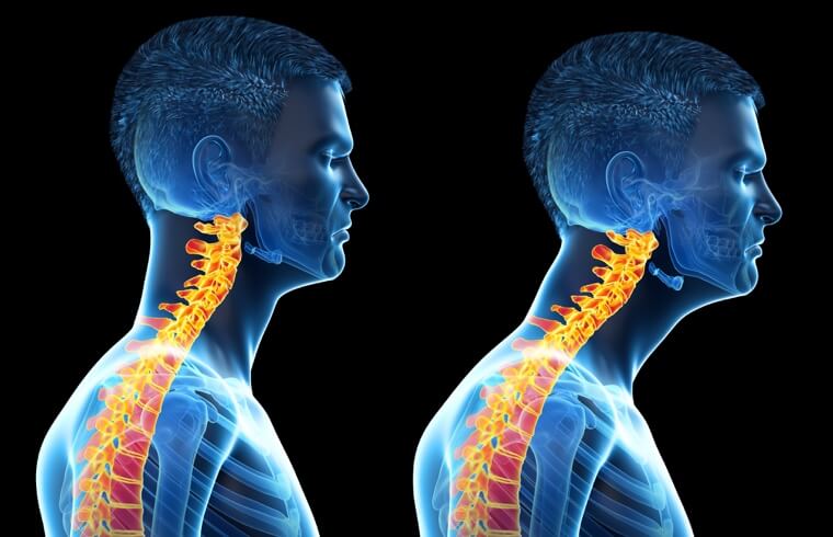 7 Ways To Improve Neck Posture